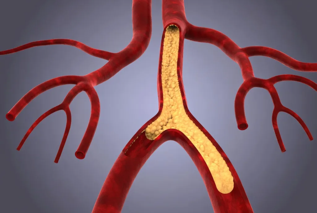 Understanding Clogged Arteries